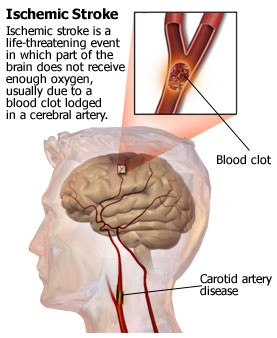 imagini ischemia cerebrala